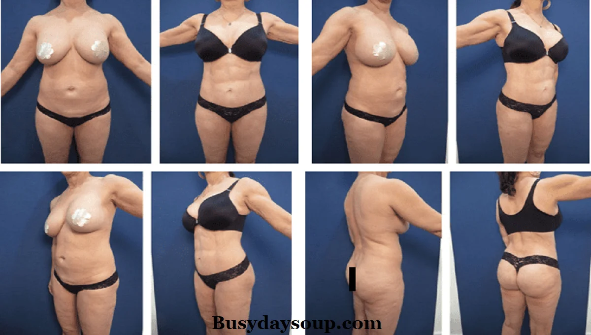 After surgery, following the aftercare instructions given by your surgeon is crucial for the best results. Proper care not only speeds up the recovery process but also helps minimize scarring and ensures the long-lasting effects of the tummy tuck. 
