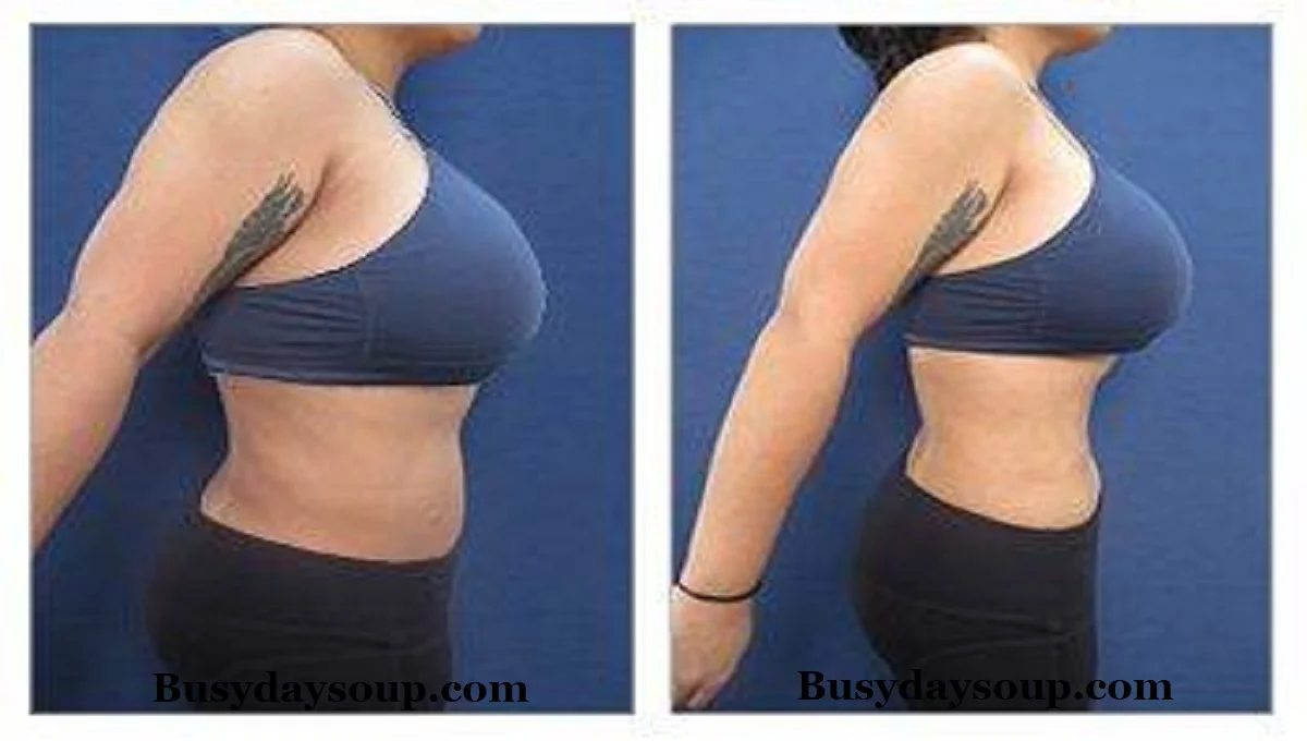 A tummy tuck is a popular cosmetic surgery for individuals looking to tighten and tone their abdomen. Whether you're dealing with post-pregnancy skin or just struggling with stubborn belly fat, this procedure promises a more youthful, smooth, and sculpted appearance.
