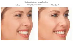 Masseter Botox is gaining immense popularity for its ability to slim the face, relieve TMJ pain, and enhance facial aesthetics. Many people seek masseter Botox before and after transformations to see how it can impact their face shape, jawline, and smile.